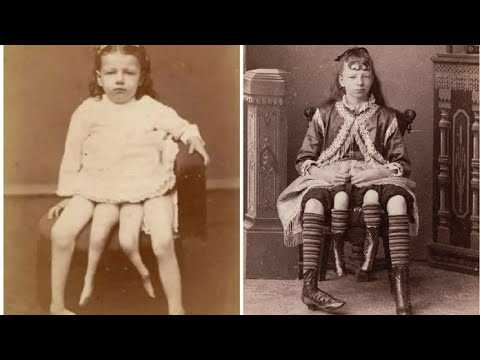 Неплакса миртл: как четырёхногая девочка-экспонат смогла войти в историю утончённой особой