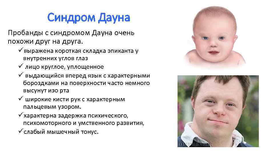 Почему разные носки синдром дауна - autizmy-net.ru