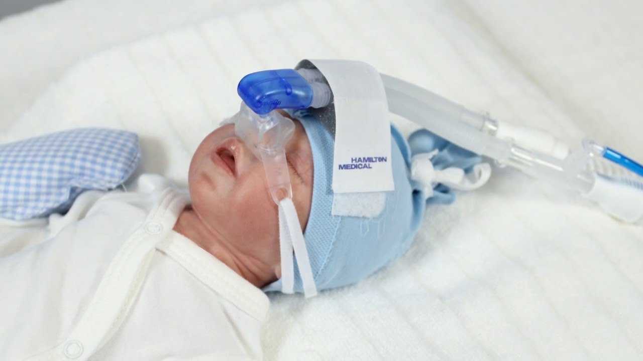Искусственная вентиляция новорожденного