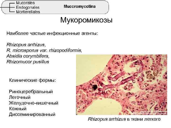 Мукормикоз черная плесень после коронавируса - кгбуз горбольница №12