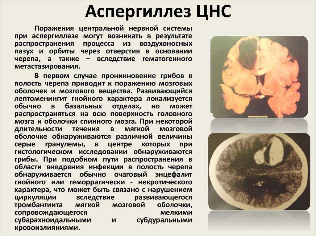 Грибовидный микоз - симптомы болезни, профилактика и лечение грибовидного микоза, причины заболевания и его диагностика на eurolab
