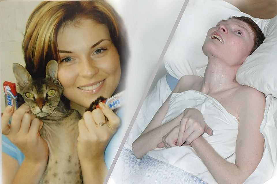 Десять лет спустя: как живёт одна из самых серьёзно пострадавших при пожаре в клубе «хромая лошадь» — рт на русском