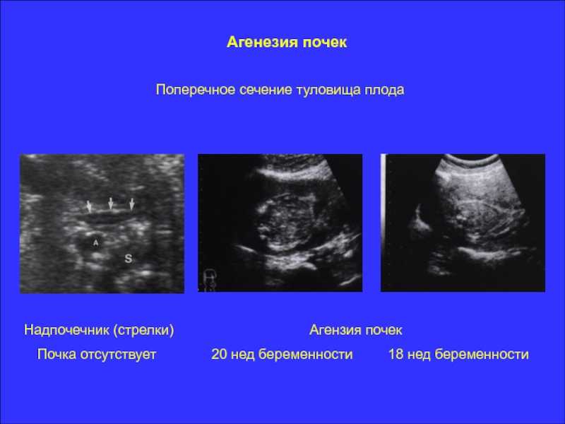 «отсутствие мотивации и знаний» – почему детям из новокузнецка не делают пересадку почек