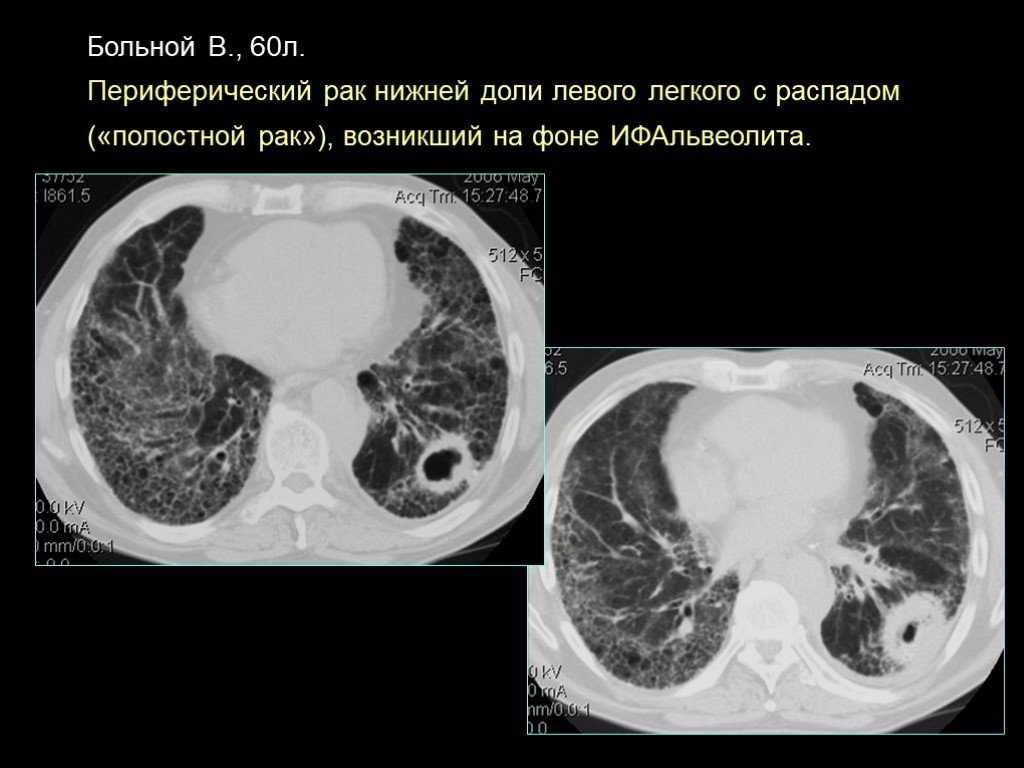 Первый признак шизофрении: распознать и остановить