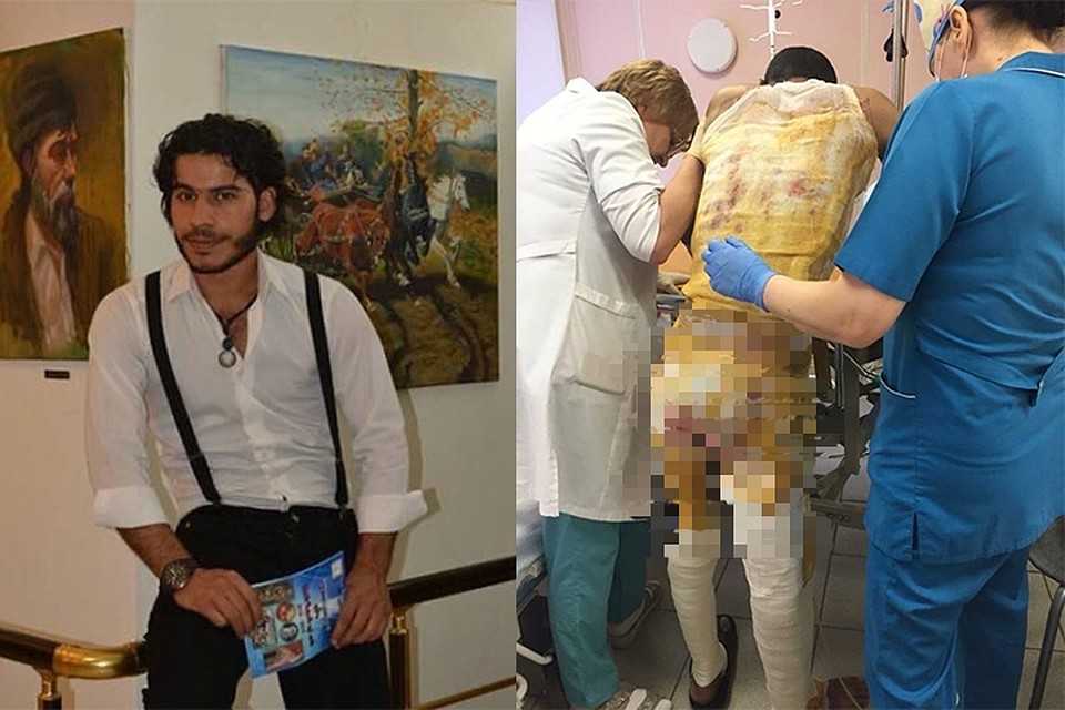 Обожженный студент марван принял участие в программе «на самом деле»